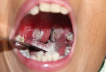 Bệnh bạch hầu: Không được chủ quan