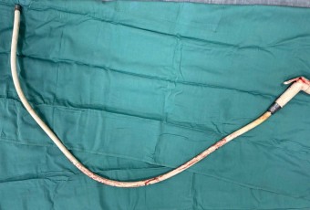 Cố tự lấy dị vật, người đàn ông suýt phải mang hậu môn nhân tạo