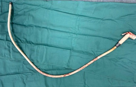 Cố tự lấy dị vật, người đàn ông suýt phải mang hậu môn nhân tạo