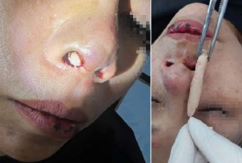Sau nâng mũi, người phụ nữ phải tháo toàn bộ sụn vì tai nạn